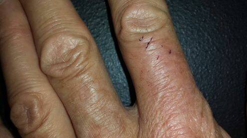 The WIRES volunteer's finger as it heals after being bitten by the eastern brown snake last week. Photo: Facebook  