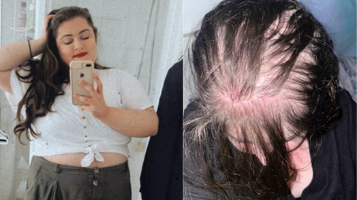 I started losing my hair at 26, here's what it taught me